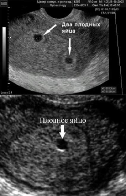 ултразвук бременност миометриум разширени вени